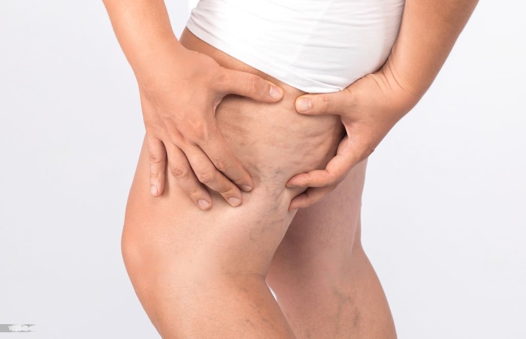 Lipocavitation Radiofréquences Innova Skin Belcodène
