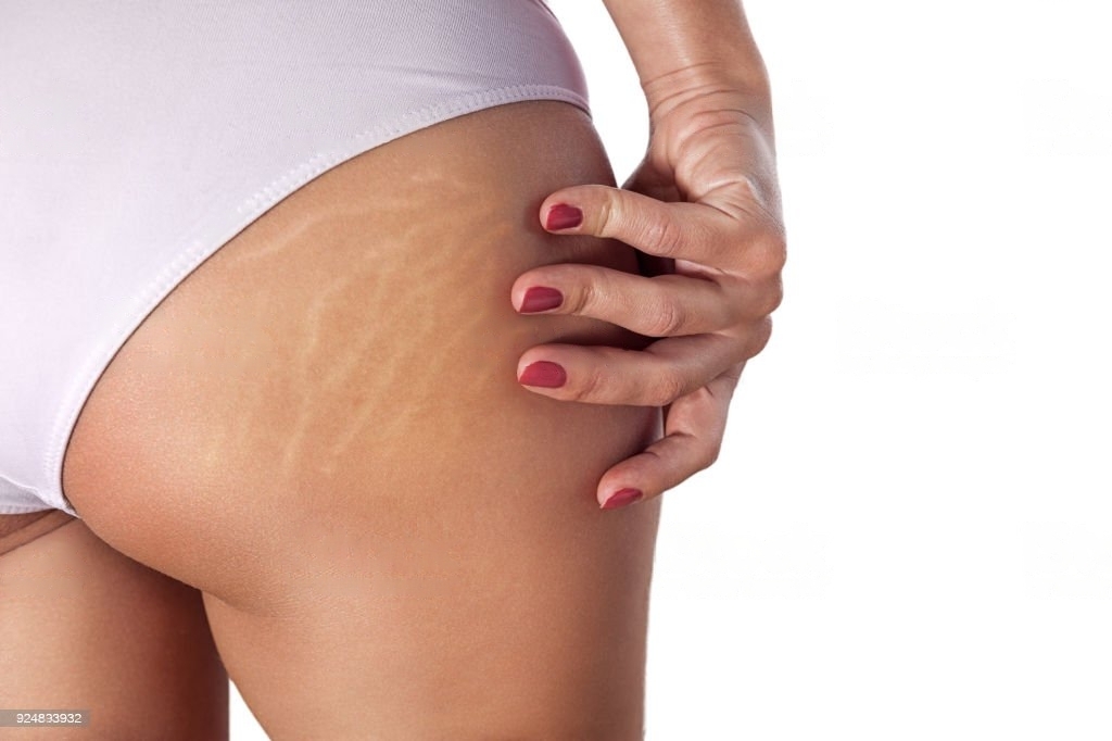 Lipocavitation Radiofréquences Innova Skin Belcodène